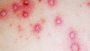 Forma de presentarse la varicela en niños y adultos