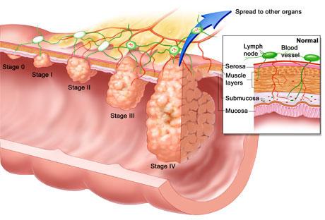 El cáncer del colon y sus tratamientos