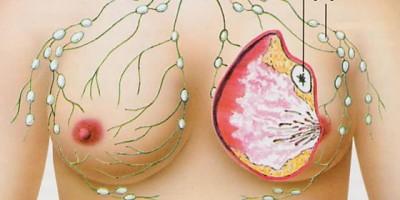 Casos y situaciones de la presencia del cáncer de mama