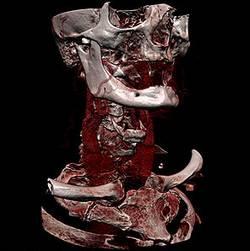 tomografia reconstruccion 3D Así funciona un tomógrafo computado