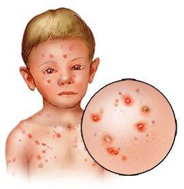 Prevención y tratamiento de la varicela