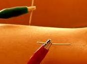 Electroacupuntura para aliviar dolores musculares