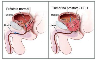 Incidencia del cáncer de próstata a nivel mundial