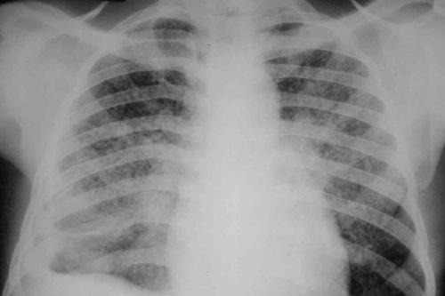 Los tipos más frecuentes de tuberculosis que afectan nuestra salud