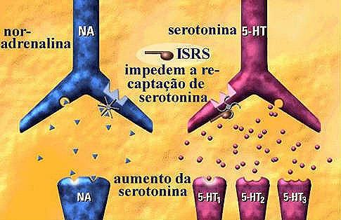 Un tipo de antidepresivo podría aumentar el riesgo de accidente cerebrovascular hemorrágico