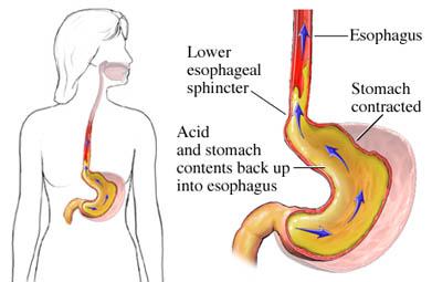 Los síntomas de reflujo ácido y de intestino irritable suelen superponerse