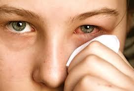 Tratamientos naturales para la conjuntivitis