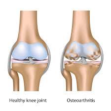 Pilates para el dolor articular de rodilla por Osteoartritis