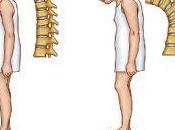 columna vertebral medida avanza Osteoporosis