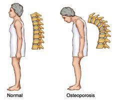 La columna vertebral a medida que avanza la Osteoporosis