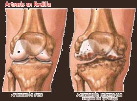 La utilidad de Pilates para casos de artrosis de rodilla