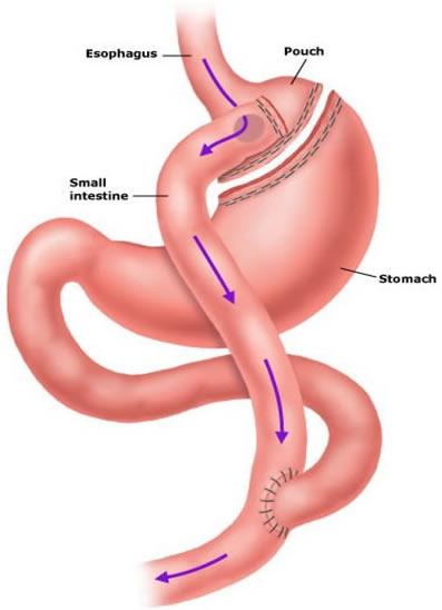 La cirugía para perder peso disminuye los riesgos cardiacos