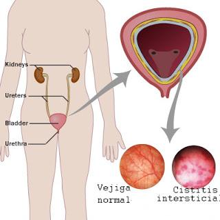 No confundir cistitis intersticial (CI) con ... ITU recurrente/endometriosis/vulvodinia/vejiga hiperactiva