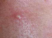 Grano infectado, antes después