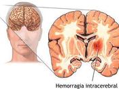 ictus segunda causa muerte mayores años