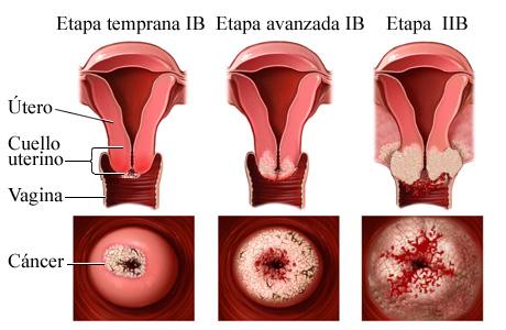 Los diferentes tratamientos para el cáncer de cuello de útero