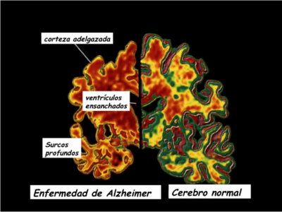 ¿Qué sabemos de la enfermedad de Alzheimer?