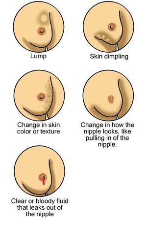 Los tipos de cáncer de mama más frecuentes que afectan al organismo