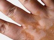 Suplementos L-Fenilalanina para repigmentar vitiligo