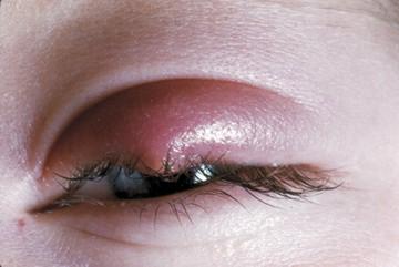 Nuestro ojo afectado por un orzuelo