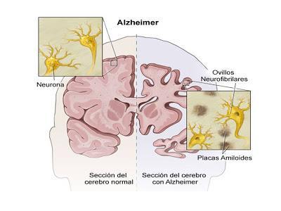 Enfermedad de Alzheimer