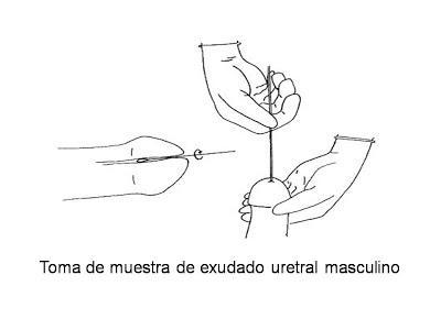 Uretritis y cervicitis