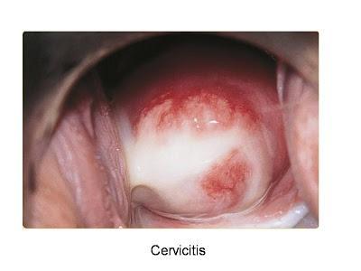 Uretritis y cervicitis