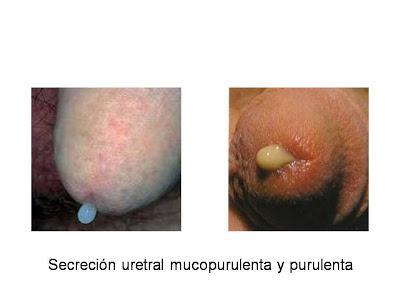 Uretritis y cervicitis