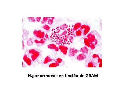 Uretritis y cervicitis