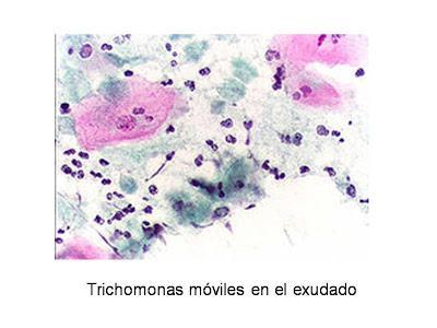 Uretritis y cervicitis