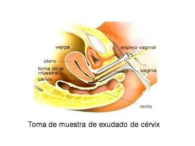 Uretritis y cervicitis