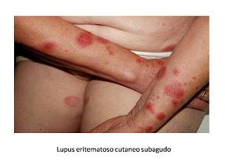 Lupus eritematoso sistémico: Aspectos prácticos para el médico de familia
