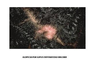 Lupus eritematoso sistémico: Aspectos prácticos para el médico de familia