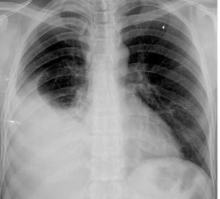Síntomas y tratamiento del derrame pleural