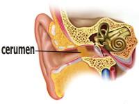 Procedimientos para la limpieza del cerumen de los oídos