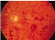 Allergan recibe la opinión positiva del CHMP en Europa para el tratamiento del edema macular provocado por oclusión de la vena retiniana