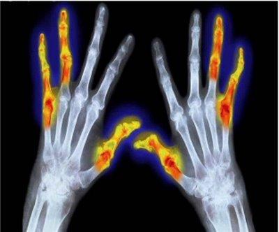 artritis reumatoidea