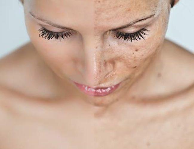 ¿Cómo se pueden eliminar o quitar las manchas de la cara?