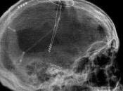 enfermedad Alzheimer podría ayudar combatir gracias marcapasos cerebrales