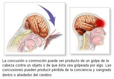 Las conmociones cerebrales pueden causar interrupciones cerebrales
