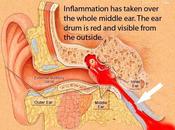 madre síntomas otitis