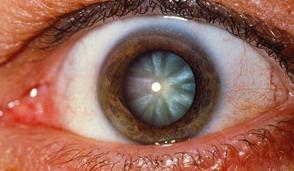 La catarata, una enfermedad sin causa posible de su aparición