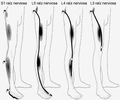 Diferentes formas de presentarse la ciática en nuestro cuerpo y organismo