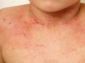 Dermatitis atopica, enfermedad crónica poco reconocida