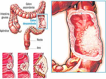 Generalidades de la presencia de un cáncer de intestino