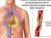 Formas identificar angina pecho