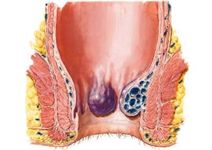 La importancia de detectar hemorroides afectando nuestra salud