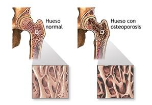 OSTEOPOROSIS