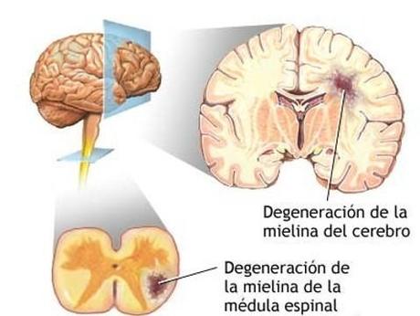 ¿Cómo afecta la esclerosis múltiple a nuestro organismo?