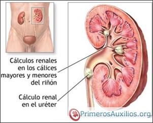 Síntomas y remedios caseros para los cálculos renales.